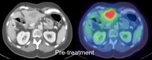 Response Assessment in rectal cancer - Pre-treatment scan
