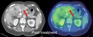 Response Assessment in rectal cancer - Post-treatment scan